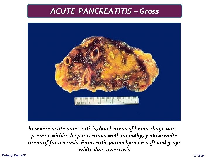ACUTE PANCREATITIS – Gross In severe acute pancreatitis, black areas of hemorrhage are present