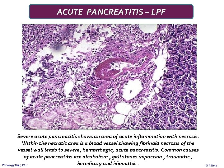 ACUTE PANCREATITIS – LPF Severe acute pancreatitis shows an area of acute inflammation with