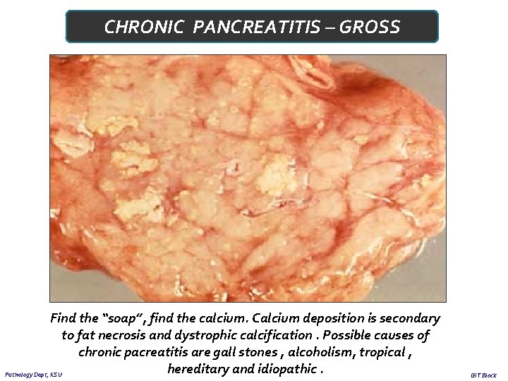 CHRONIC PANCREATITIS – GROSS Find the “soap”, find the calcium. Calcium deposition is secondary