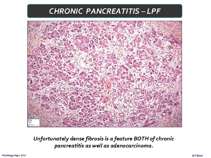 CHRONIC PANCREATITIS – LPF Unfortunately dense fibrosis is a feature BOTH of chronic pancreatitis