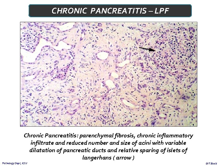 CHRONIC PANCREATITIS – LPF Chronic Pancreatitis: parenchymal fibrosis, chronic inflammatory infiltrate and reduced number
