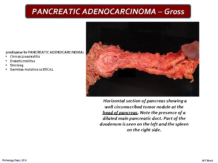 PANCREATIC ADENOCARCINOMA – Gross predispose to PANCREATIC ADENOCARCINOMA: • Chronic pancreatitis • Diabetic mellitus
