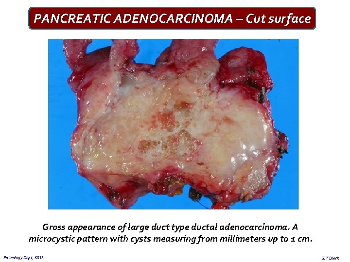 PANCREATIC ADENOCARCINOMA – Cut surface Gross appearance of large duct type ductal adenocarcinoma. A