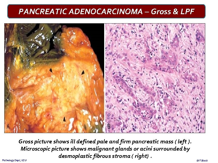PANCREATIC ADENOCARCINOMA – Gross & LPF Gross picture shows ill defined pale and firm