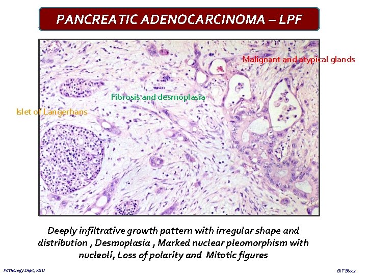 PANCREATIC ADENOCARCINOMA – LPF Malignant and atypical glands Fibrosis and desmoplasia Islet of Langerhans