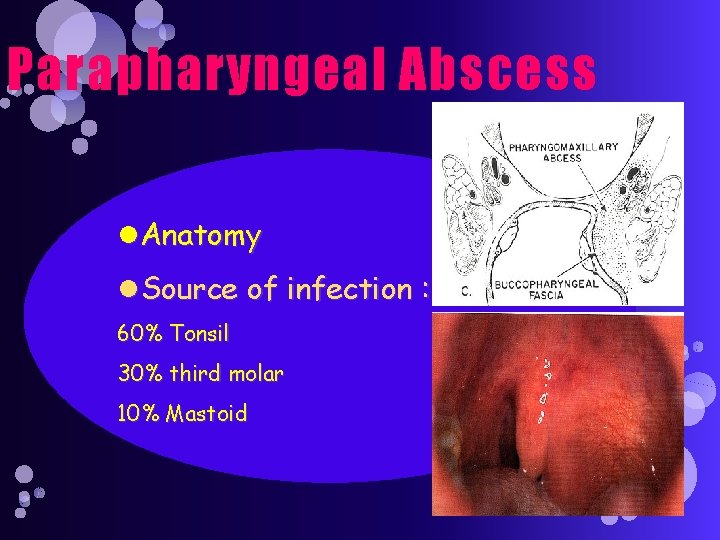 Parapharyngeal Abscess Anatomy Source of infection : 60% Tonsil 30% third molar 10% Mastoid
