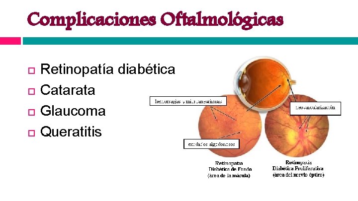 Complicaciones Oftalmológicas Retinopatía diabética Catarata Glaucoma Queratitis 
