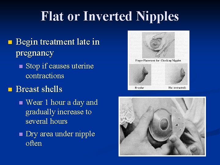 Flat or Inverted Nipples n Begin treatment late in pregnancy n n Stop if
