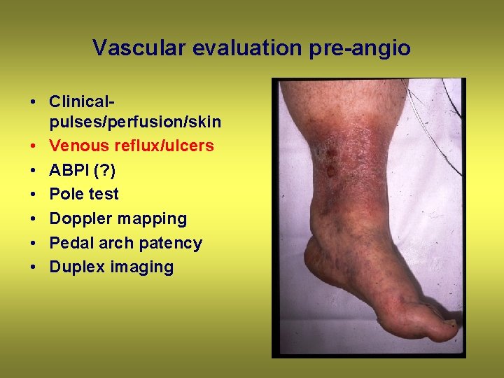 Vascular evaluation pre-angio • Clinicalpulses/perfusion/skin • Venous reflux/ulcers • ABPI (? ) • Pole