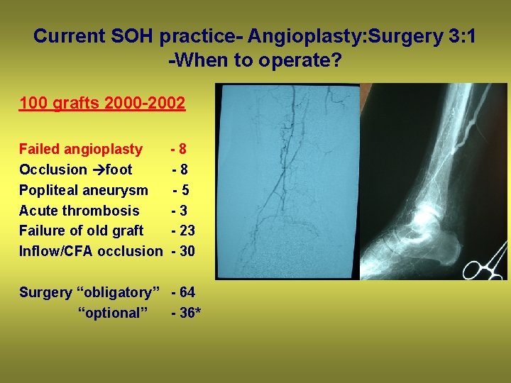 Current SOH practice- Angioplasty: Surgery 3: 1 -When to operate? 100 grafts 2000 -2002