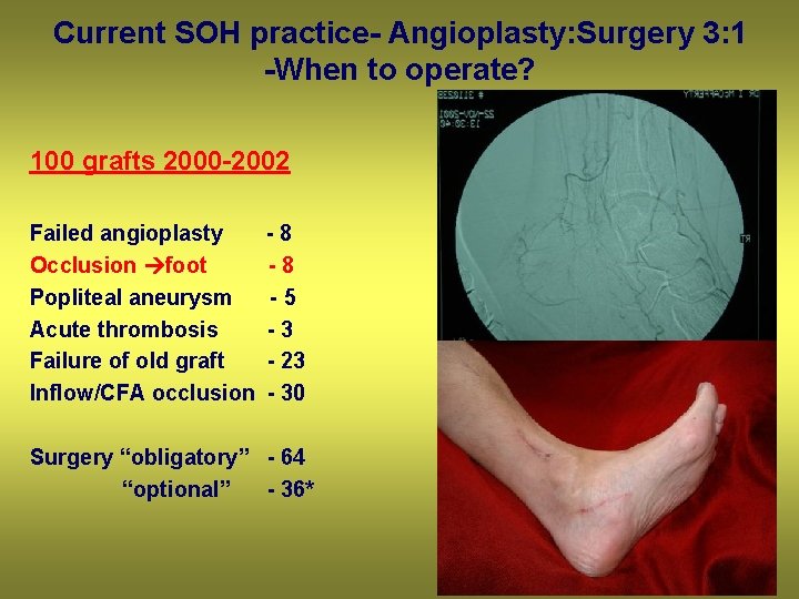 Current SOH practice- Angioplasty: Surgery 3: 1 -When to operate? 100 grafts 2000 -2002