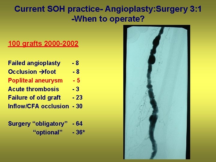 Current SOH practice- Angioplasty: Surgery 3: 1 -When to operate? 100 grafts 2000 -2002