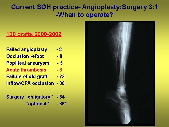 Current SOH practice- Angioplasty: Surgery 3: 1 -When to operate? 100 grafts 2000 -2002