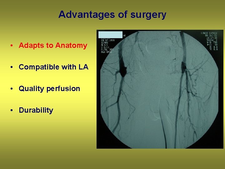 Advantages of surgery • Adapts to Anatomy • Compatible with LA • Quality perfusion