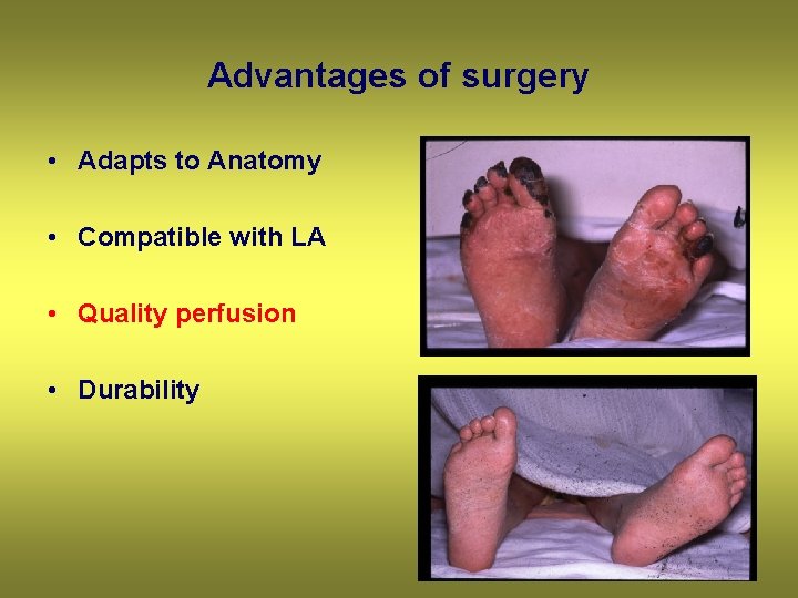 Advantages of surgery • Adapts to Anatomy • Compatible with LA • Quality perfusion