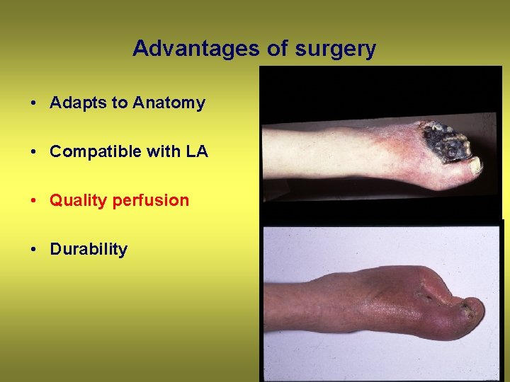 Advantages of surgery • Adapts to Anatomy • Compatible with LA • Quality perfusion