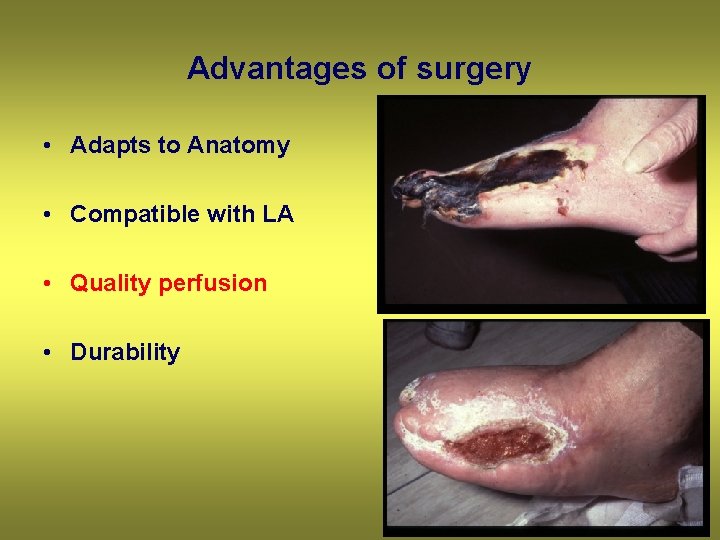 Advantages of surgery • Adapts to Anatomy • Compatible with LA • Quality perfusion