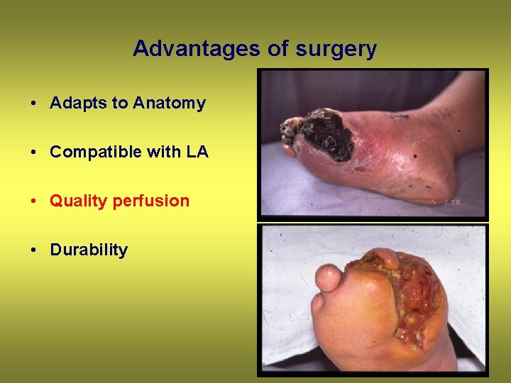 Advantages of surgery • Adapts to Anatomy • Compatible with LA • Quality perfusion