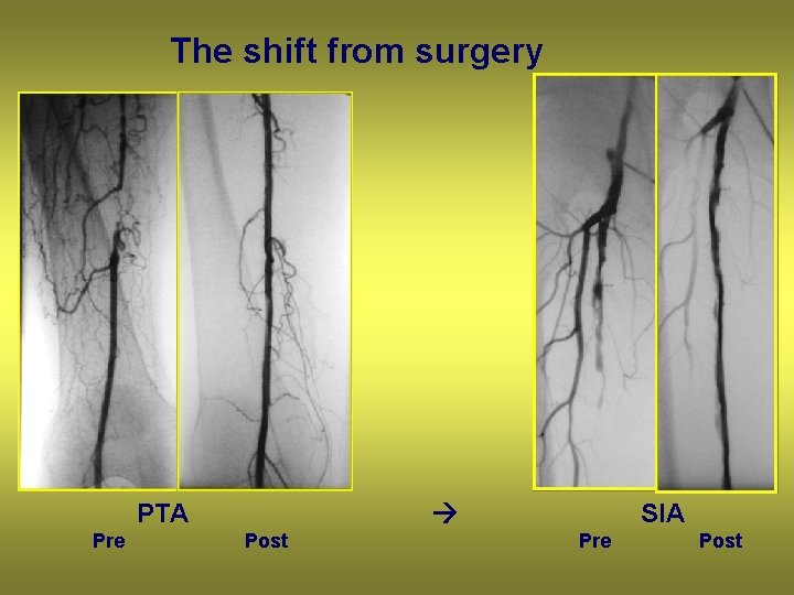 The shift from surgery PTA Pre SIA Post Pre Post 