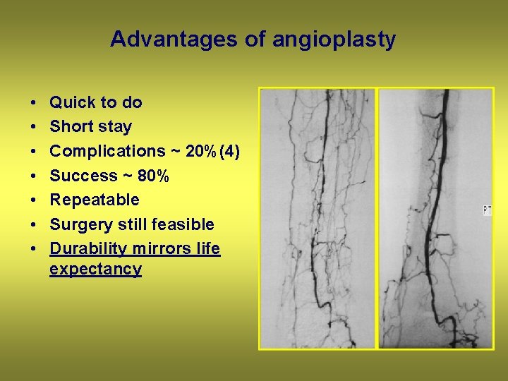 Advantages of angioplasty • • Quick to do Short stay Complications ~ 20%(4) Success