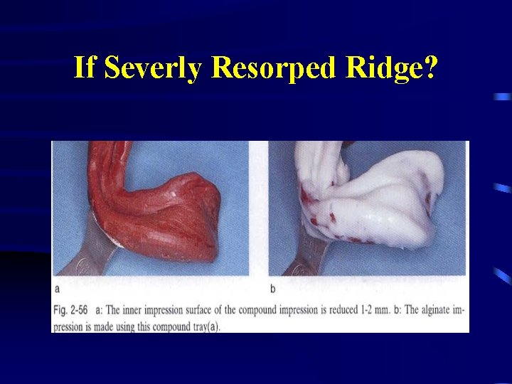 If Severly Resorped Ridge? 
