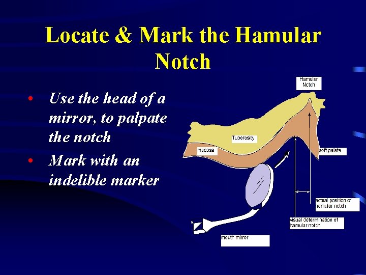 Locate & Mark the Hamular Notch • Use the head of a mirror, to