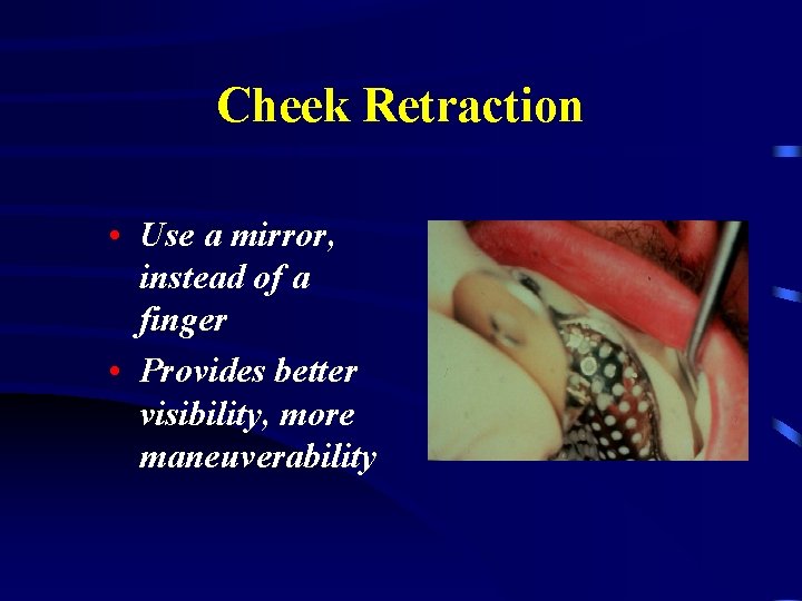 Cheek Retraction • Use a mirror, instead of a finger • Provides better visibility,