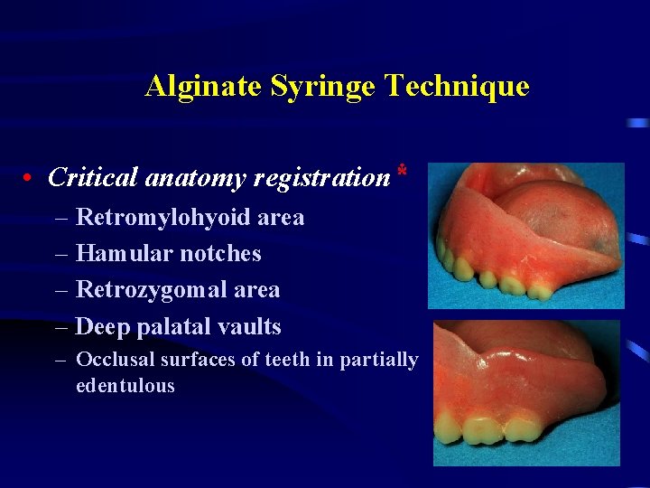 Alginate Syringe Technique • Critical anatomy registration* – Retromylohyoid area – Hamular notches –