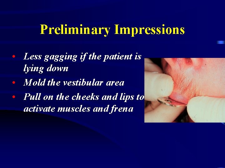 Preliminary Impressions • Less gagging if the patient is lying down • Mold the