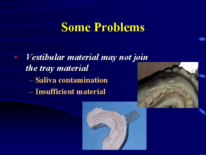 Some Problems • Vestibular material may not join the tray material – Saliva contamination