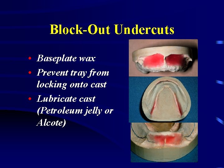 Block-Out Undercuts • Baseplate wax • Prevent tray from locking onto cast • Lubricate
