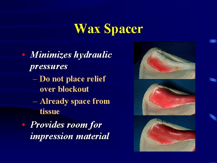 Wax Spacer • Minimizes hydraulic pressures – Do not place relief over blockout –