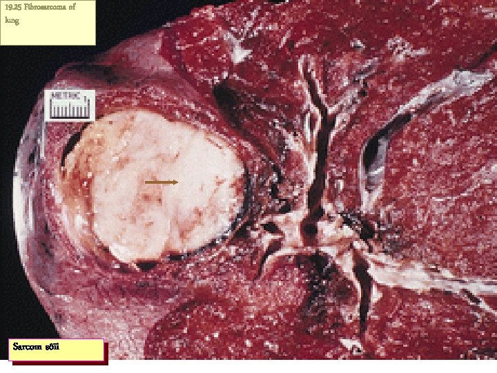 19. 25 Fibrosarcoma of lung Sarcom sôïi 