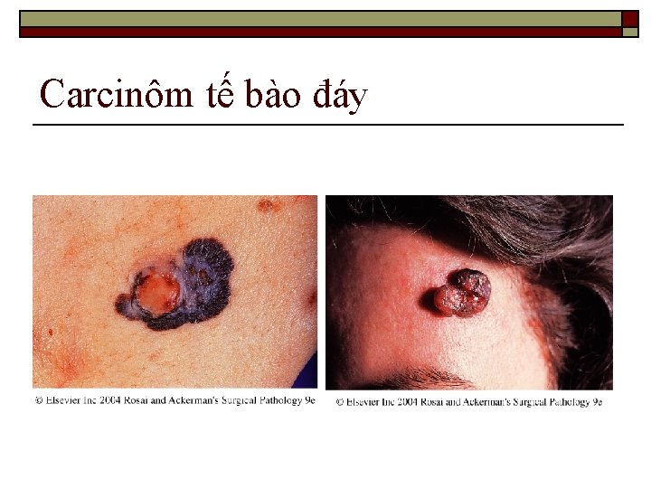 Carcinôm tế bào đáy 