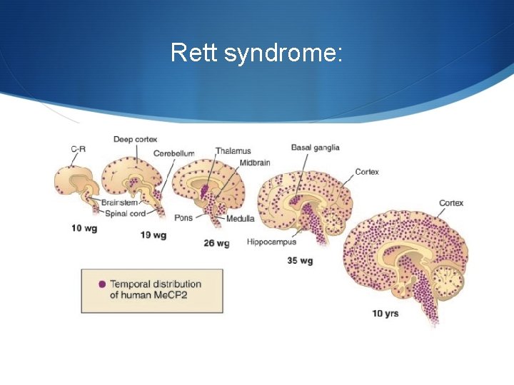 Rett syndrome: 