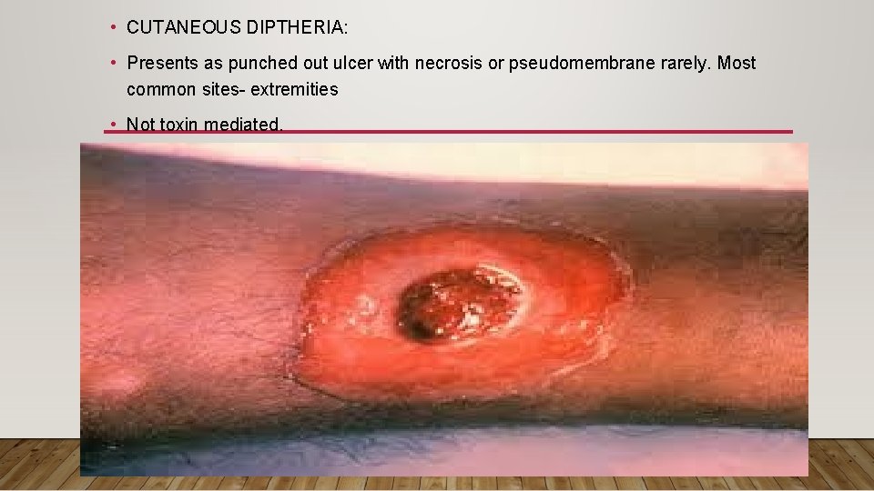  • CUTANEOUS DIPTHERIA: • Presents as punched out ulcer with necrosis or pseudomembrane