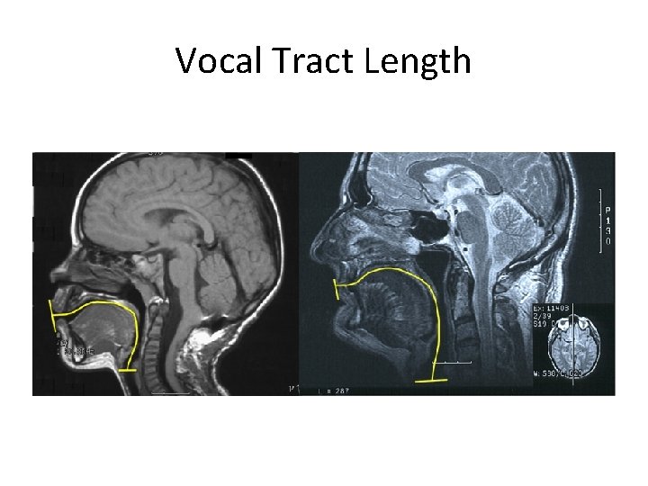 Vocal Tract Length 