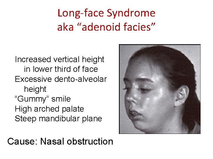 Long-face Syndrome aka “adenoid facies” Increased vertical height in lower third of face Excessive