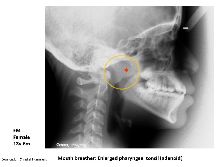 * FM Female 13 y 6 m Source: Dr. Christel Hummert Mouth breather; Enlarged