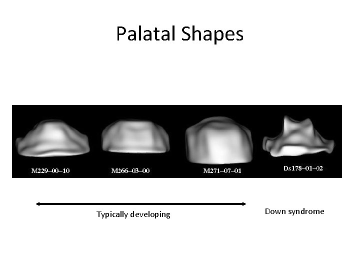 Palatal Shapes Typically developing Down syndrome 