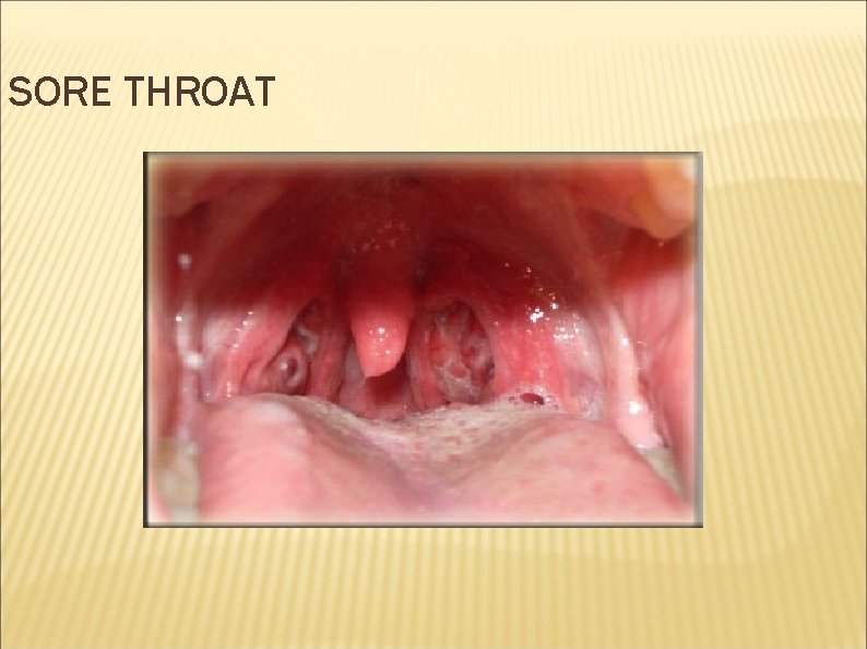 SORE THROAT 