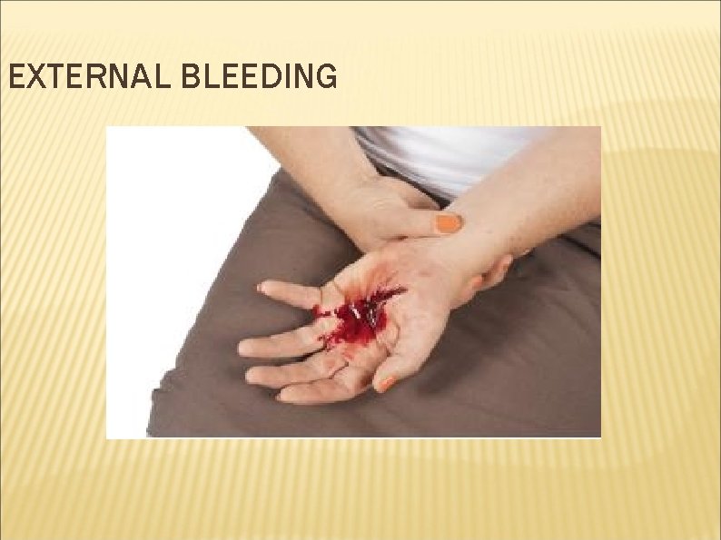 EXTERNAL BLEEDING 