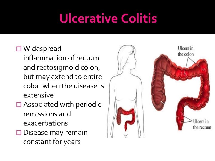 Ulcerative Colitis � Widespread inflammation of rectum and rectosigmoid colon, but may extend to