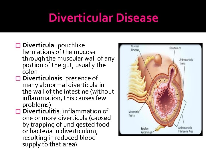 Diverticular Disease � Diverticula: pouchlike herniations of the mucosa through the muscular wall of