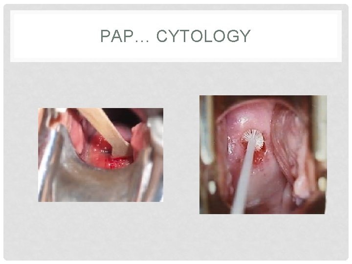 PAP… CYTOLOGY 