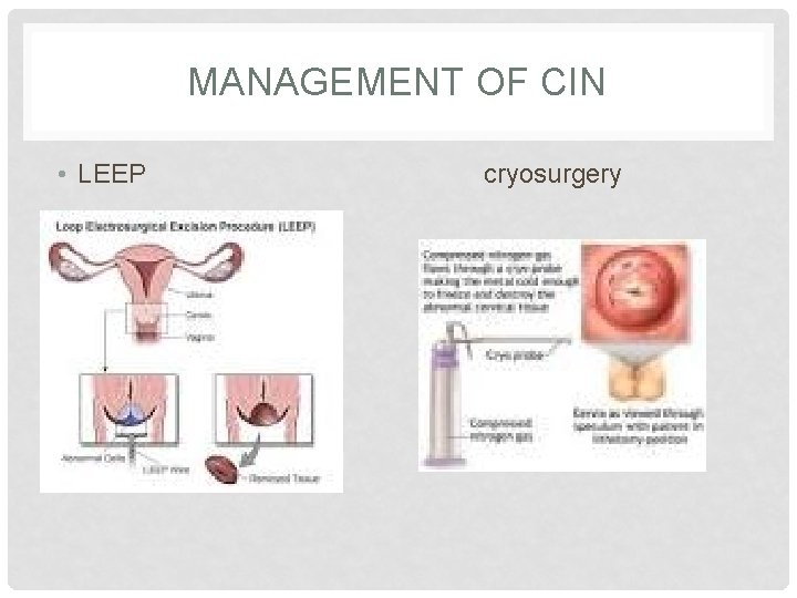 MANAGEMENT OF CIN • LEEP cryosurgery 