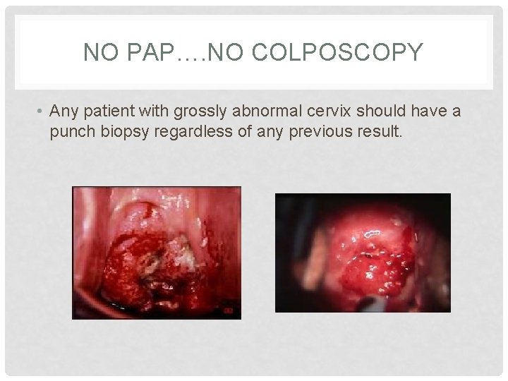 NO PAP…. NO COLPOSCOPY • Any patient with grossly abnormal cervix should have a