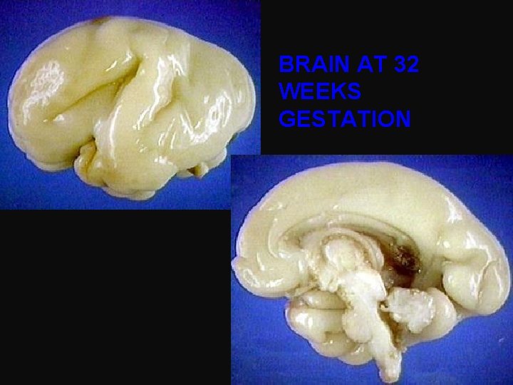 BRAIN AT 32 WEEKS GESTATION 