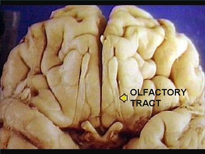 OLFACTORY TRACT 