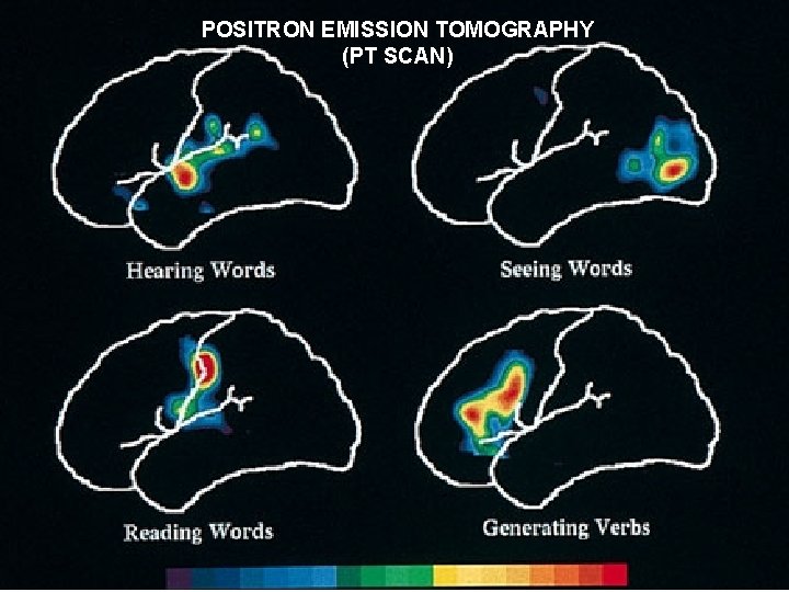 POSITRON EMISSION TOMOGRAPHY (PT SCAN) 
